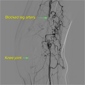 Blocked Leg Artery - Angioplasty