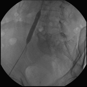 Deployment of balloon mounted stent-graft – Angiogram Procedures